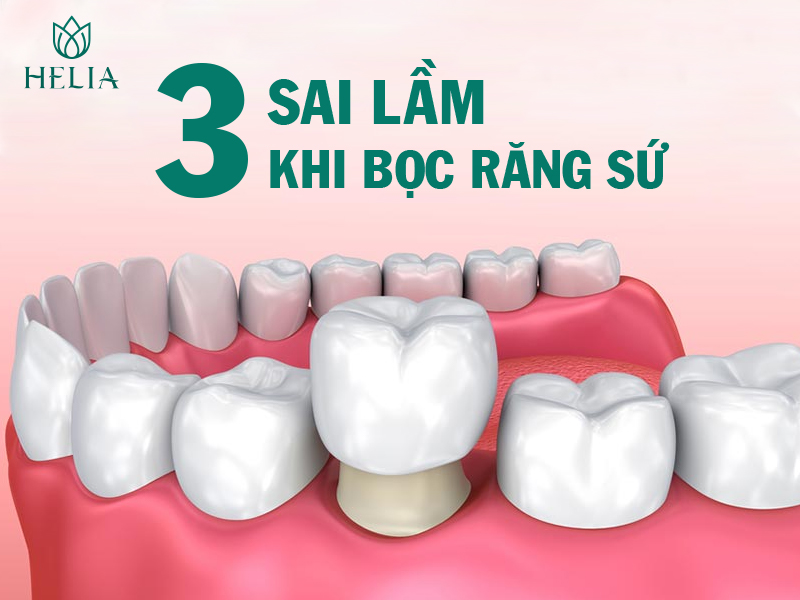 3 sai lầm khi bọc răng sứ