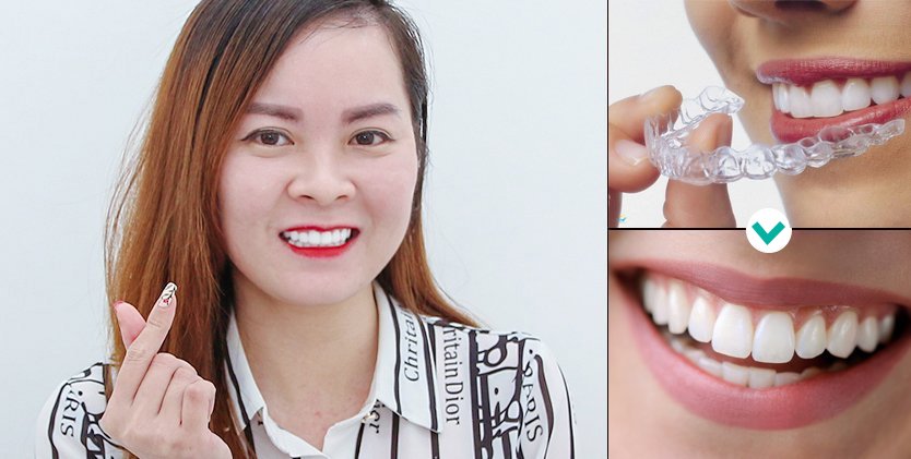 Niềng răng trong suốt Invisalign tại HELIA